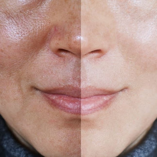 Consultation (IPL)