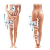 Endermo. jambes lourdes